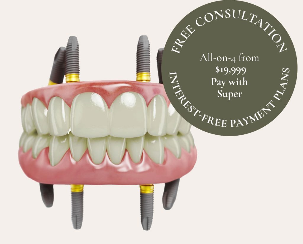 All-on-4 implants- Sydney Dental Hub Thornleigh
